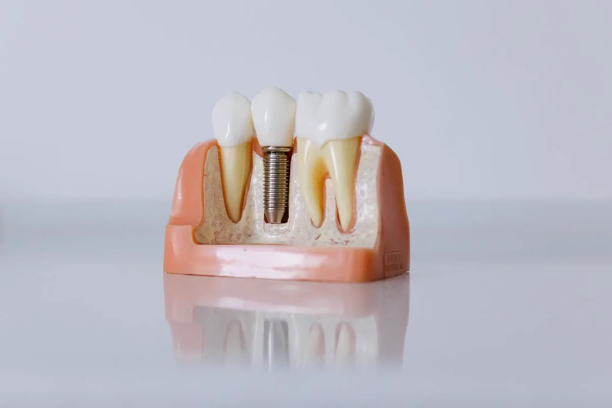 Imagen de referencia de un implante dental